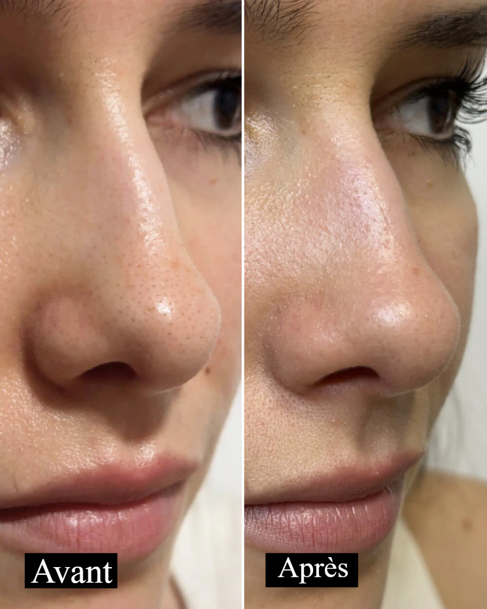 Patchs Anti-Points Noirs Nexora