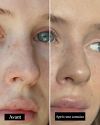 Patchs Anti-Points Noirs Nexora