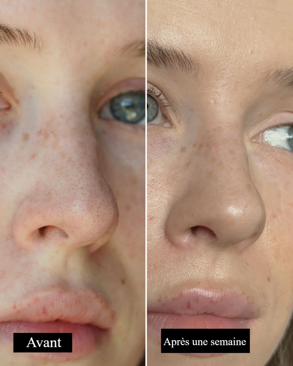 Patchs Anti-Points Noirs Nexora